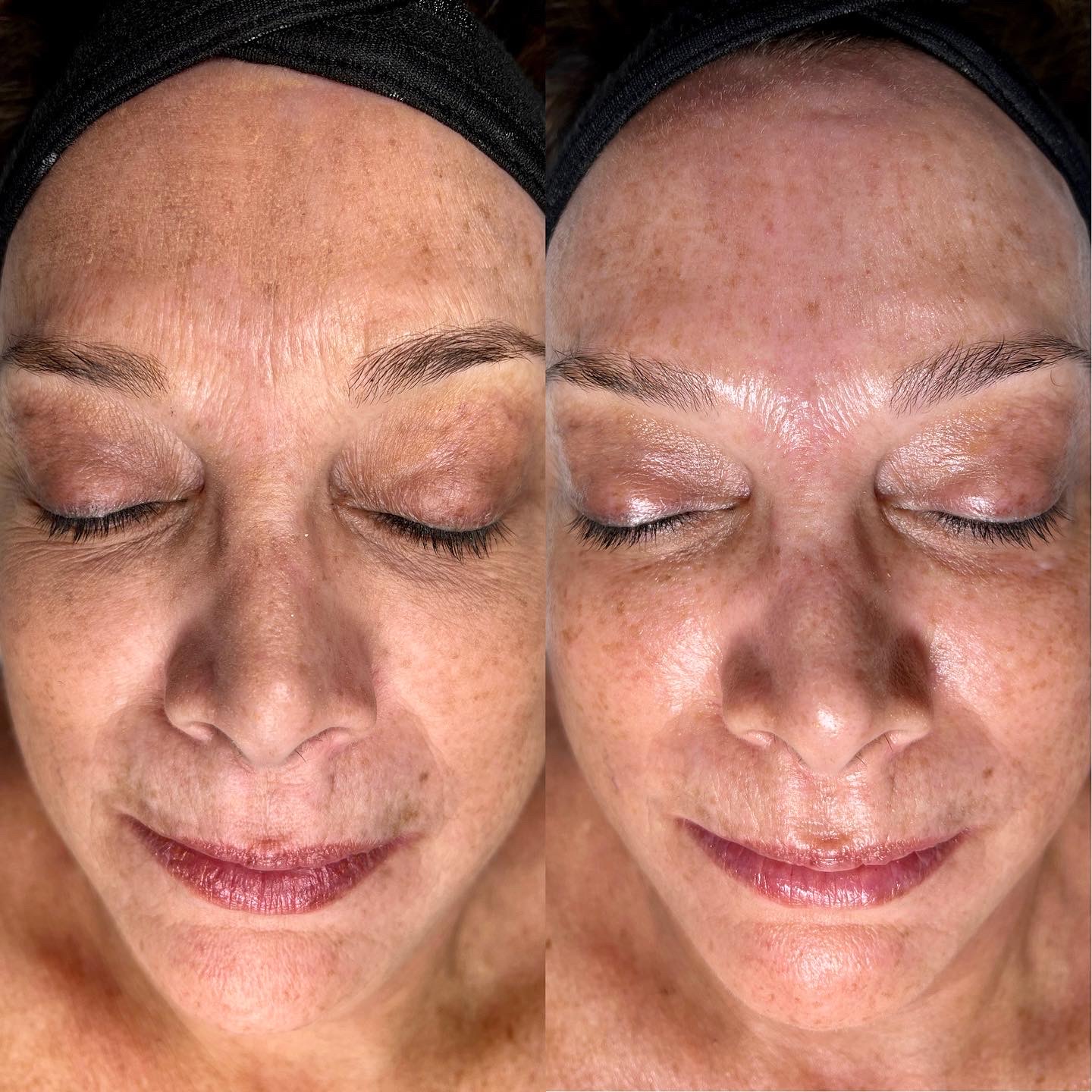 before and after facial