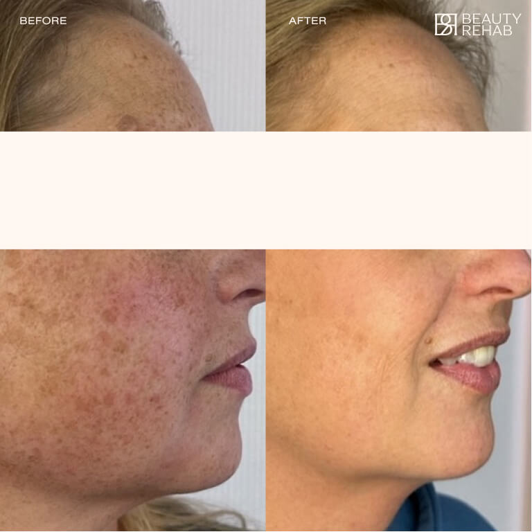 Pigment reduction with ZO and Chemical Peels